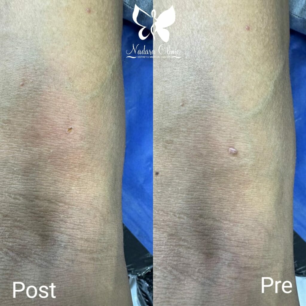 Laser skin tag removal